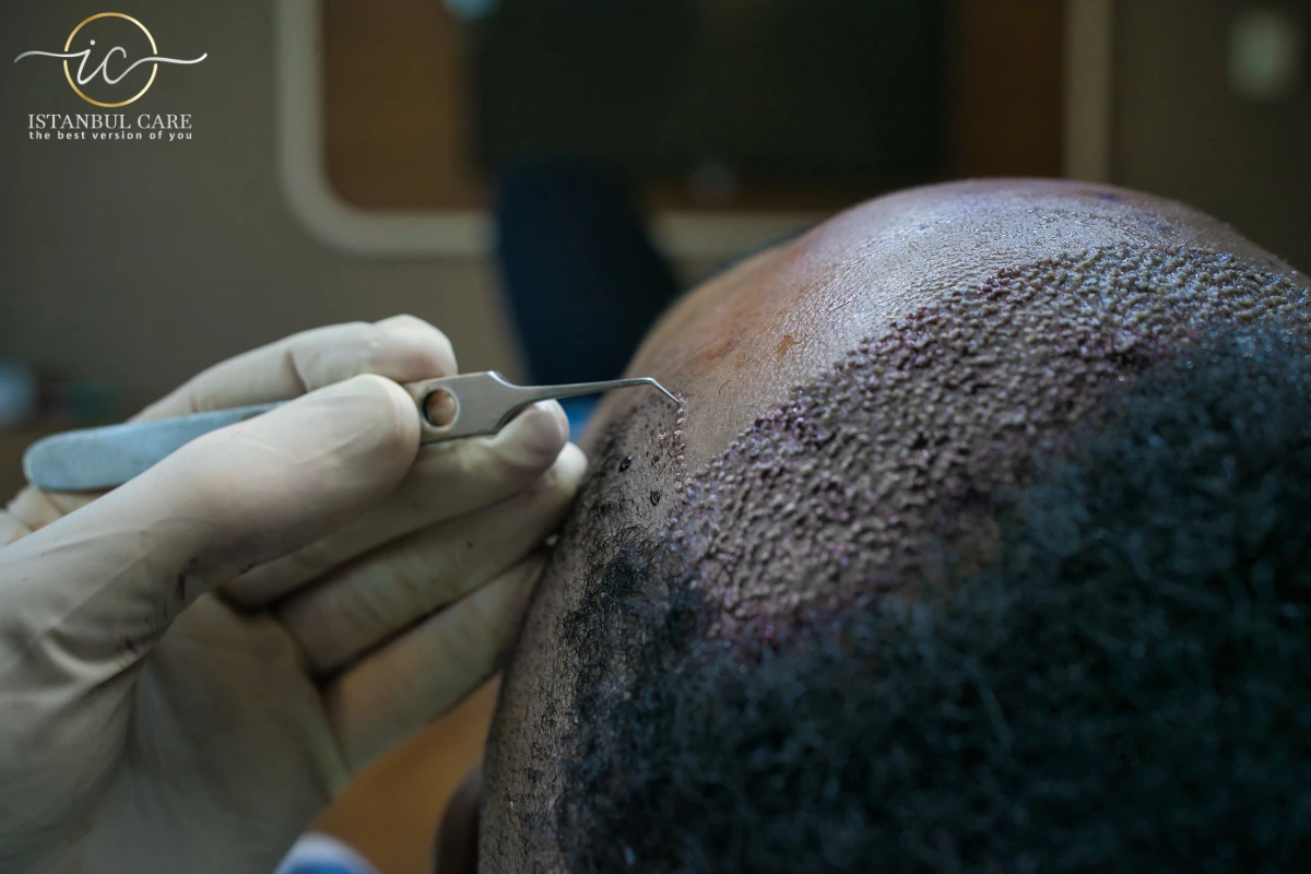 What is The Average Price of FUE Hair Transplant in Turkey