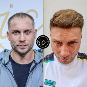 Transplantimi i flokeve ne Turqi, Transplantimi i flokeve - Transplanti i flokeve ne Turqi Hair Transplant Before After 1