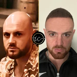 Transplantimi i flokeve ne Turqi, Transplantimi i flokeve - Transplanti i flokeve ne Turqi Hair Transplant Before After 10