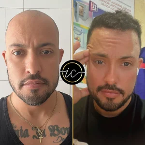Transplantimi i flokeve ne Turqi, Transplantimi i flokeve - Transplanti i flokeve ne Turqi Hair Transplant Before After 12