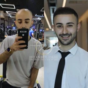 Transplantimi i flokeve ne Turqi, Transplantimi i flokeve - Transplanti i flokeve ne Turqi Hair Transplant Before After 14
