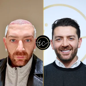 Transplantimi i flokeve ne Turqi, Transplantimi i flokeve - Transplanti i flokeve ne Turqi Hair Transplant Before After 15