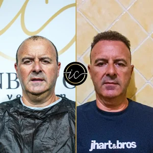 Transplantimi i flokeve ne Turqi, Transplantimi i flokeve - Transplanti i flokeve ne Turqi Hair Transplant Before After 4