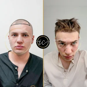 Transplantimi i flokeve ne Turqi, Transplantimi i flokeve - Transplanti i flokeve ne Turqi Hair Transplant Before After 5