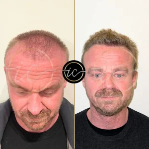 Transplantimi i flokeve ne Turqi, Transplantimi i flokeve - Transplanti i flokeve ne Turqi Hair Transplant Before After 7