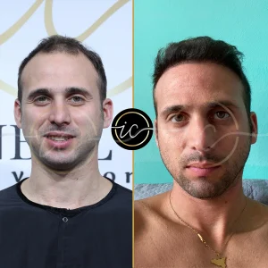 Transplantimi i flokeve ne Turqi, Transplantimi i flokeve - Transplanti i flokeve ne Turqi Hair Transplant Before After 9