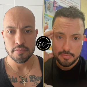 hair transplant before after in turkey
