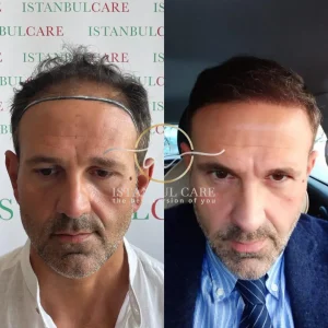 hair transplant before after istanbul-care turkey