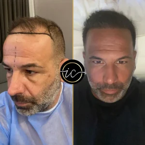 hair transplant before after istanbul clinic