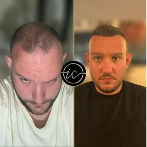 trasplante capilar antes y después - Fotos de antes y después del trasplante capilar hair transplant before after result