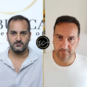 Transplante capilar - Transplante capilar na Albânia hair transplant before after result