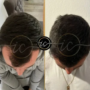 Transplante capilar - Transplante capilar na Albânia hair transplant before after photos