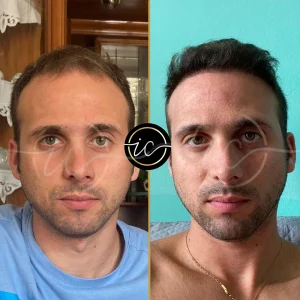Transplante capilar - Transplante capilar na Albânia hair transplant before after images