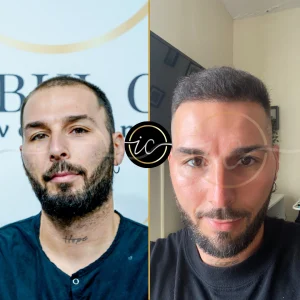 Transplante capilar - Transplante capilar na Albânia hair transplant before after photo
