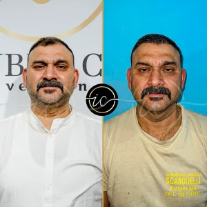 Transplante capilar - Transplante capilar na Albânia https://istanbul-care.com/es/costo-del-trasplante-capilar-dhi-en-turquia/