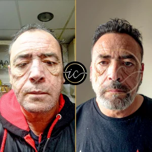 Transplante capilar - Transplante capilar na Albânia before after images for hair transplant in turkey