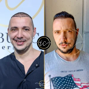 Transplante capilar - Transplante capilar na Albânia hair transplant before after istanbul-care