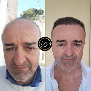 Transplante capilar - Transplante capilar na Albânia before after images for hair transplant in turkey