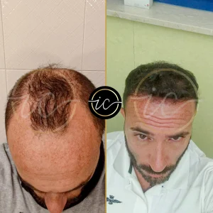 Transplante capilar - Transplante capilar na Albânia hair transplant before after