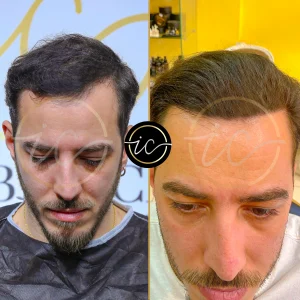 Transplante capilar - Transplante capilar na Albânia hair transplant before after istanbul
