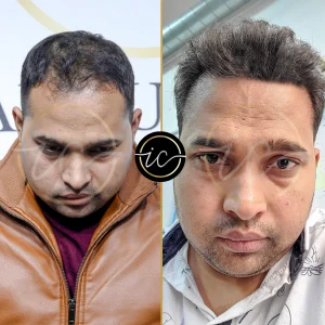 Transplante capilar - Transplante capilar na Albânia before after images for hair transplant in Istanbul