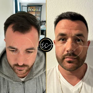 Transplante capilar - Transplante capilar na Albânia hair transplant before after turkey