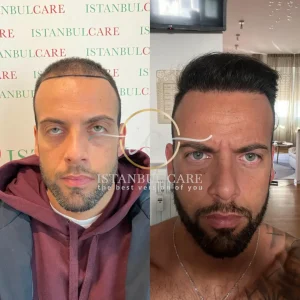 trasplante capilar antes y después - Fotos de antes y después del trasplante capilar hair transplant results istanbul care