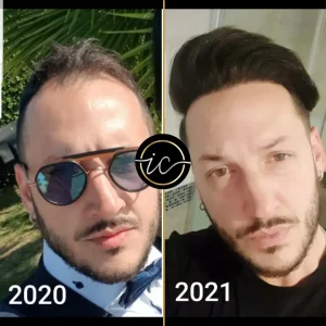 trasplante capilar antes y después - Fotos de antes y después del trasplante capilar hair transplant results turkey