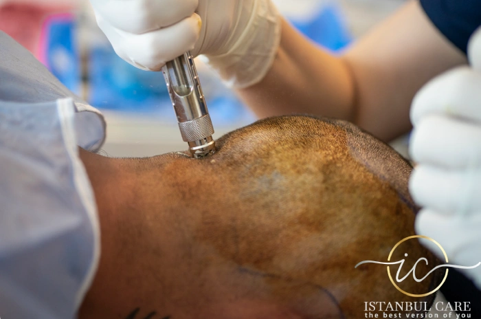 Needle-Free Hair Transplant at Istanbul Care
