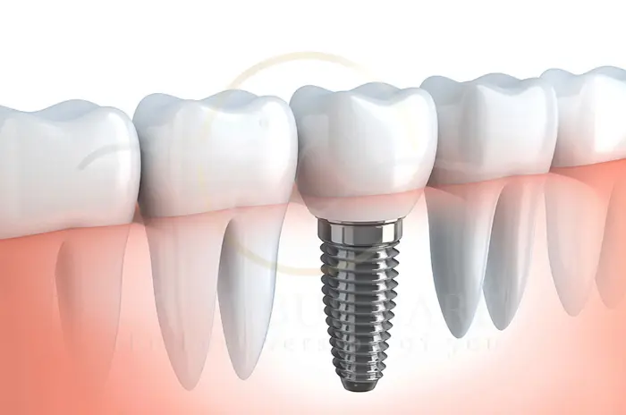 10 Best destinations to get dental implants
