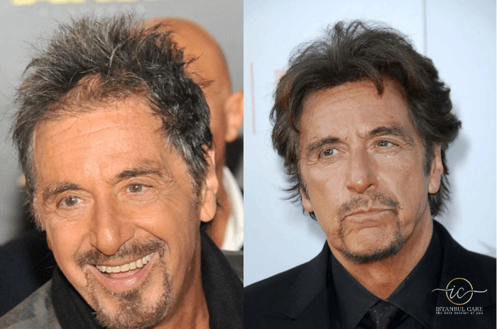Al Pacino Hair Transplant Al Pacino Hair Transplant
