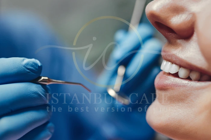 All-on-4 Dental Implants
