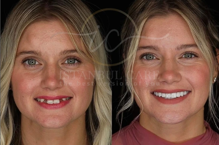 All-on-4 Dental Implants in Turkey All-on-4 Dental Implants in Turkey