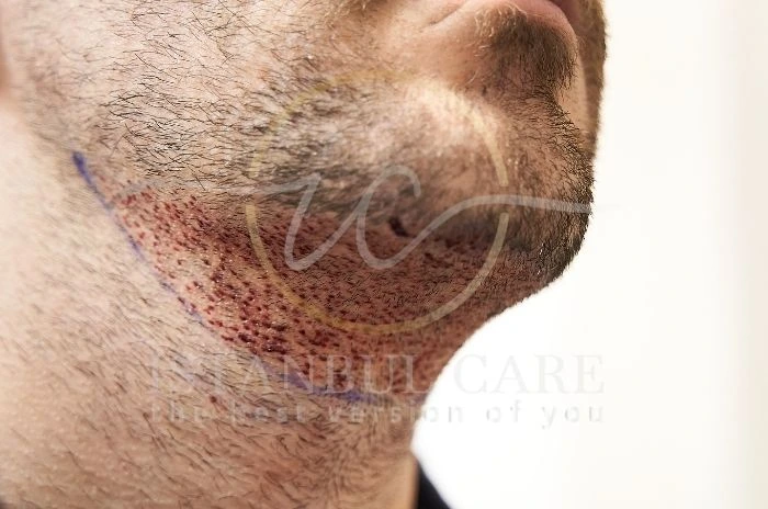 Beard Transplant Beard Transplant