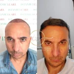 Before and After Results- Hair Transplant in Turkey vs France