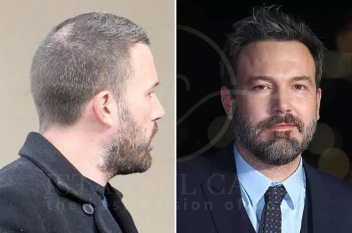 Ben Affleck Hair Transplant (1) Ben Affleck Hair Transplant