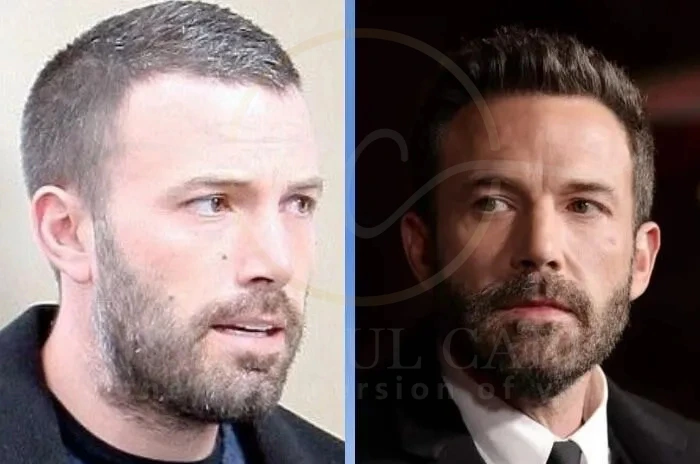 Ben Affleck Hair Transplant (2) Ben Affleck Hair Transplant
