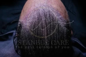 Best Hair Care Practices After a Hair Transplant