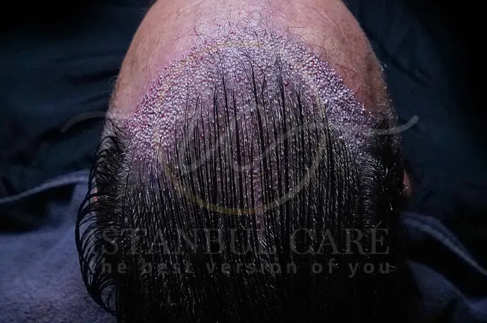 Best Hair Care Practices After a Hair Transplant