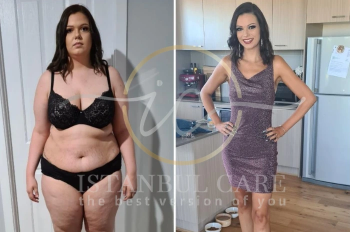 Gastric Bypass Surgery Recovery Tips (1) Gastric Bypass Surgery Recovery Tips