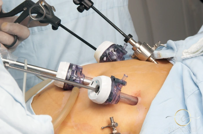 Gastric Bypass Surgery Gastric Bypass Surgery