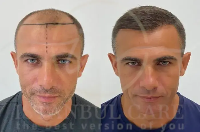 Cura del trapianto di capelli - Linee guida essenziali per il post-intervento