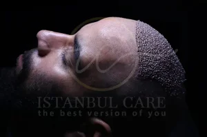 Hair Transplant Healing Process How Diet and Care Impact Recovery