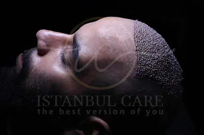 Hair Transplant Healing Process How Diet and Care Impact Recovery