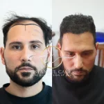 Hairline Transformation- Turkish vs French
