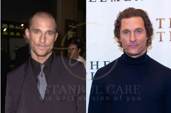 Matthew McConaughey Hair Transplant Matthew McConaughey Hair Transplant