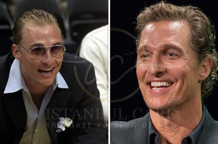 Matthew McConaughey Hair Transplants Matthew McConaughey Hair Transplant