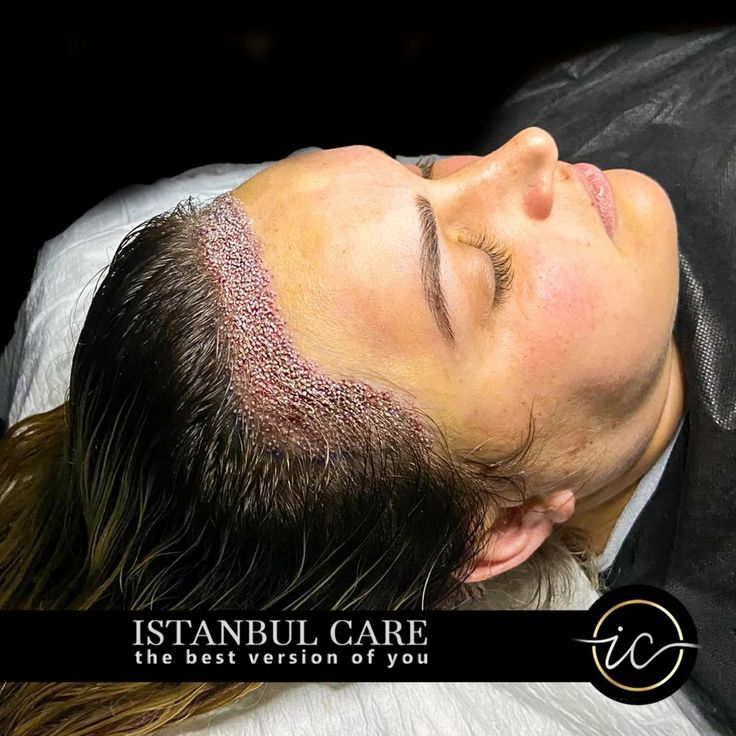 Trapianto di capelli per donne