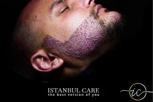 Beard transplant
