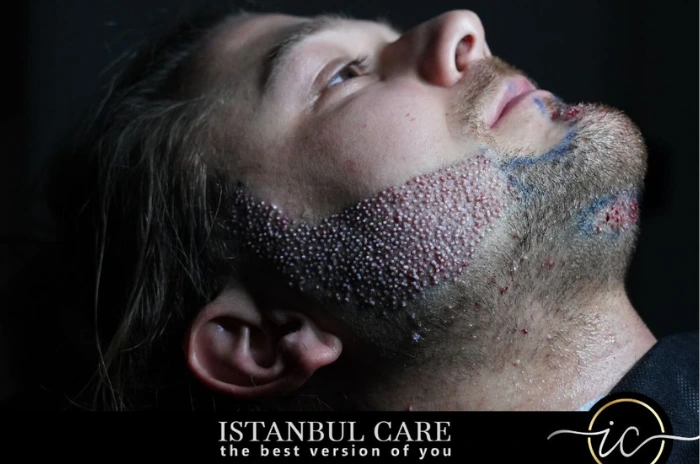 Barttransplantation Türkei